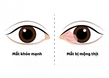 Bệnh mộng mắt (mộng thịt): Nguyên nhân ,triệu chứng và cách phòng ngừa 