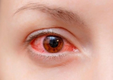 Đau mắt đỏ :Nguyên nhân ,Phòng ngừa ,Triệu chứng  